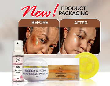 NEW REDNESS & BURN SET (PERFECT FOR MELASMA)